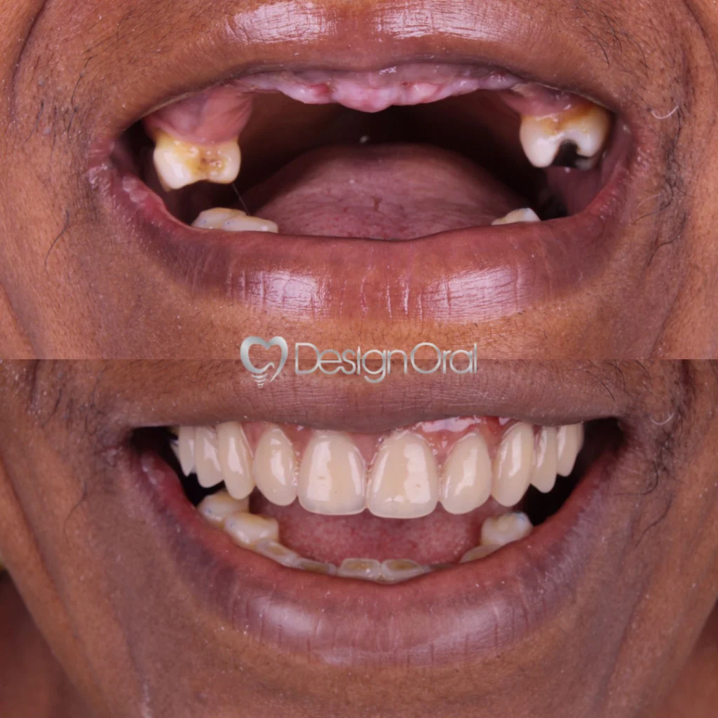 Implante Dentário no Tatuapé - Design Oral Implantes - Dentista no Tatuapé
