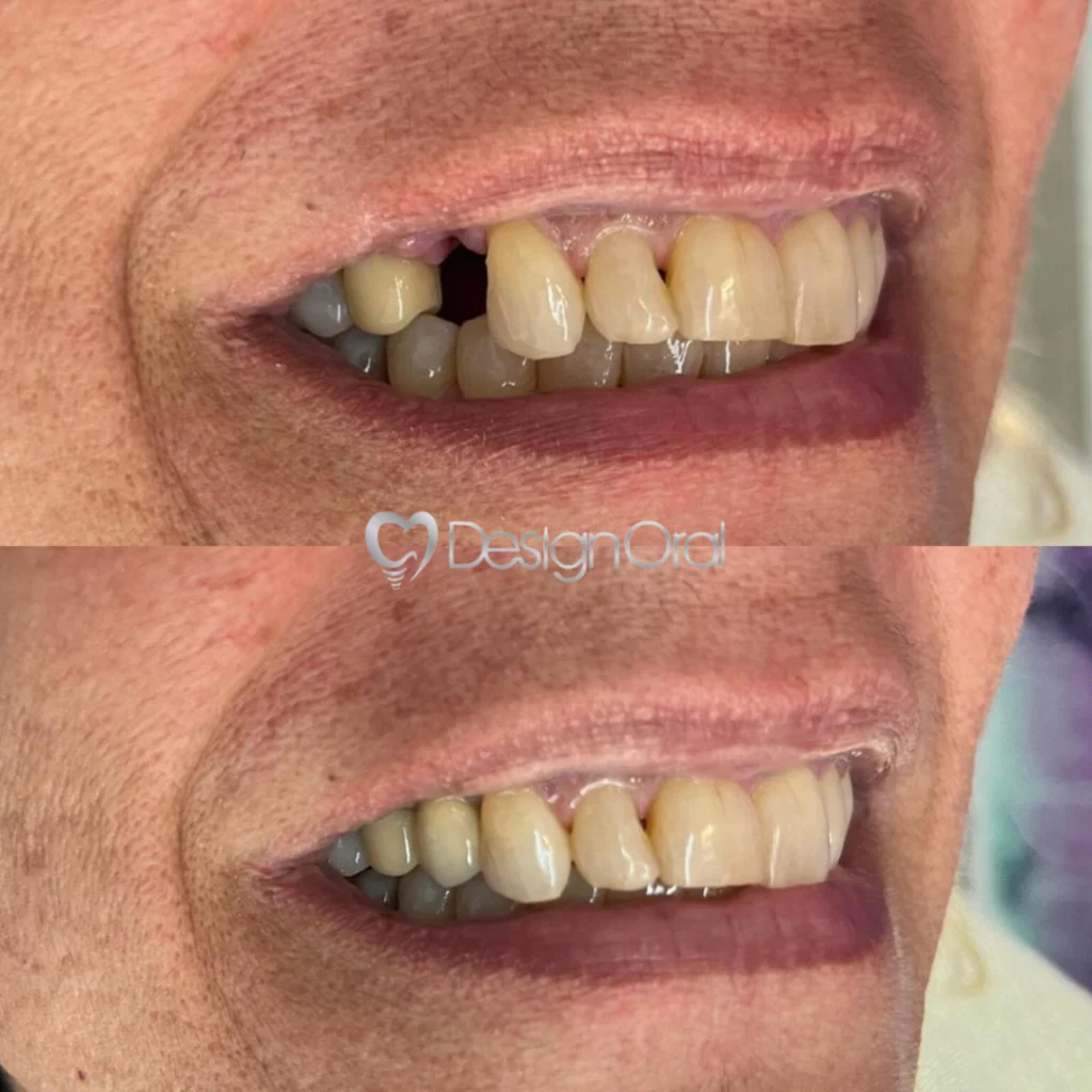 Implante Dentário no Tatuapé - Design Oral Implantes - Dentista no Tatuapé