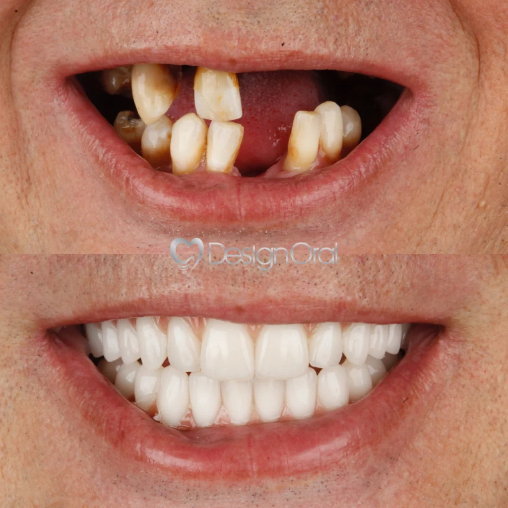 Implante Dentário no Tatuapé - Design Oral Implantes - Dentista no Tatuapé