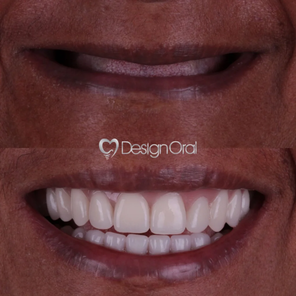 Implante Dentário no Tatuapé - Design Oral Implantes - Dentista no Tatuapé